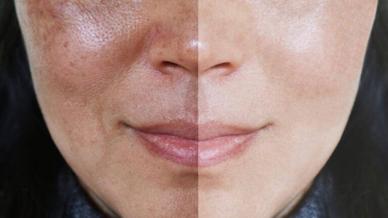 Leia mais sobre o artigo Melasma